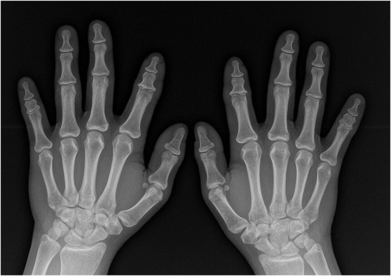 Management of failed carpal tunnel decompression.