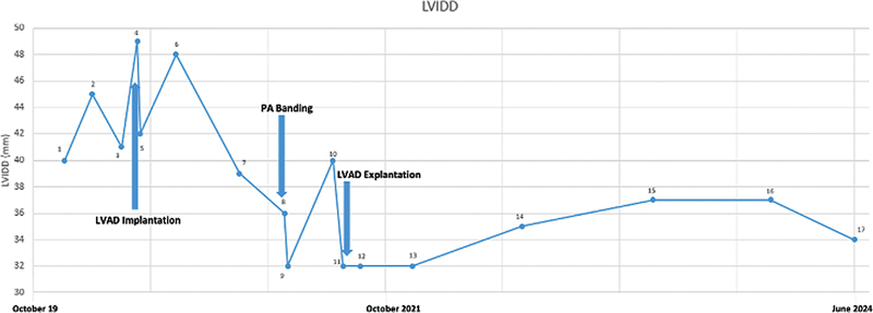 Successful Weaning off LVAD Support in an Infant by Pulmonary Artery Banding.
