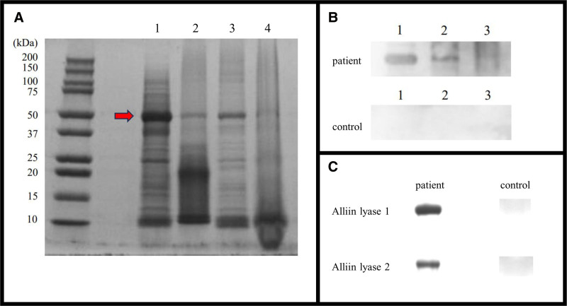 Garlic allergy in an infant: Identification of alliin lyase 1 and 2 as causative allergens.