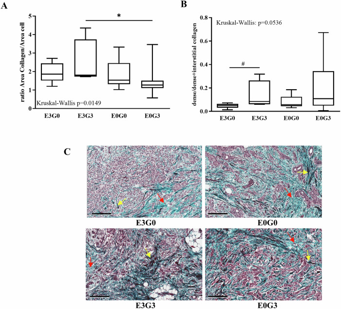 Proteomic landscape of decellularized breast carcinomas identifies C-type lectin domain family 3 member A as a driver of cancer aggressiveness.