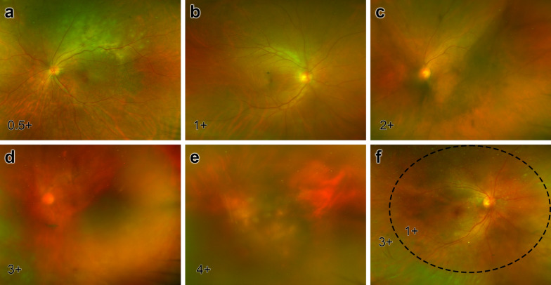 Correlation between interleukins in aqueous humor and vitreous humor of vitreoretinal lymphoma patients.