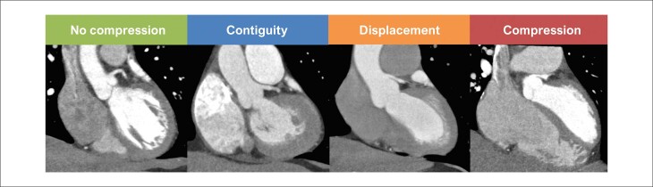 Left Main Coronary Artery Angioplasty for the Treatment of Extrinsic Compression in Patients with Pulmonary Hypertension.