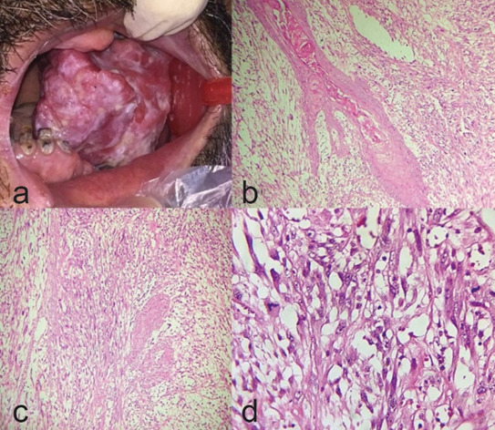 Infrequent Histopathologic Subtypes of Oral Squamous Cell Carcinoma: A Case Series with Emphasis on Histopathologic Characteristics.