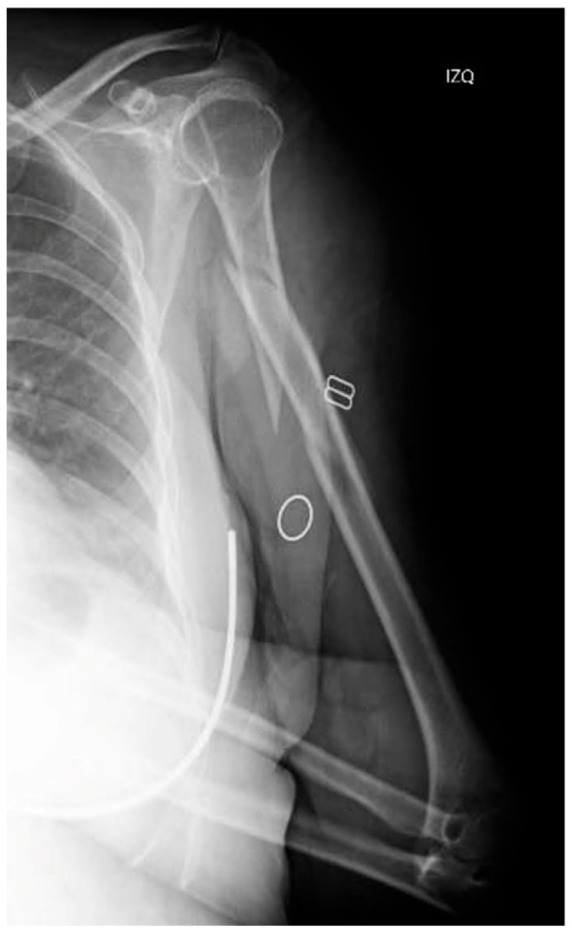 A Longitudinal Peri-Implant Diaphyseal Fracture Around a Locked Humeral Nail: A Case Report.