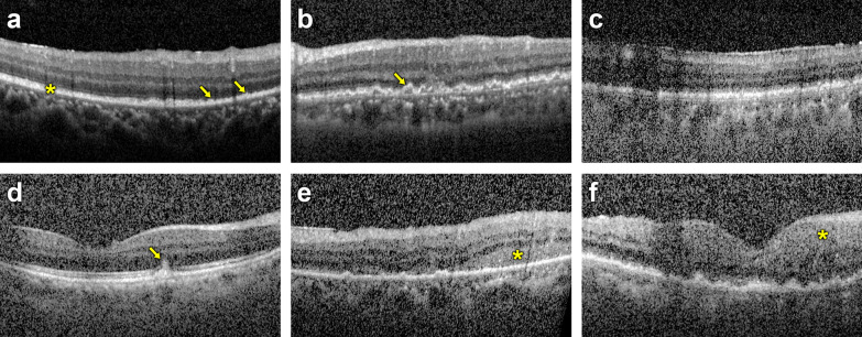 Correlation between interleukins in aqueous humor and vitreous humor of vitreoretinal lymphoma patients.