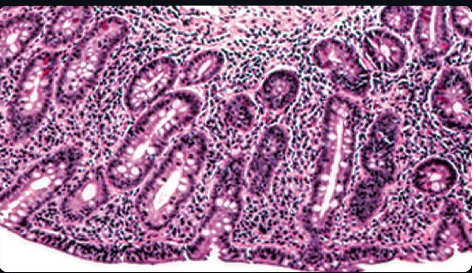Recurrent Pouchitis Uncovering De Novo Celiac Disease.