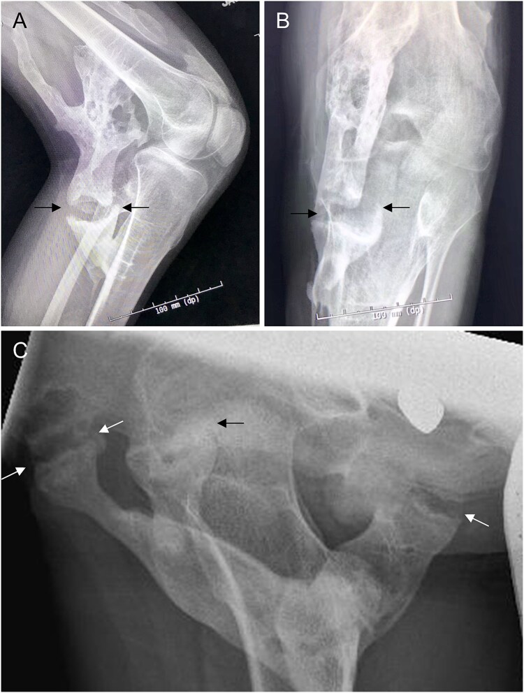 Ectopic pseudojoints in fibrodysplasia ossificans progressiva.