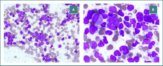 B-cell acute lymphoblastic leukemia and lymphoblastic lymphoma with p190 <i>BCR::ABL1</i> transcript: a case report.