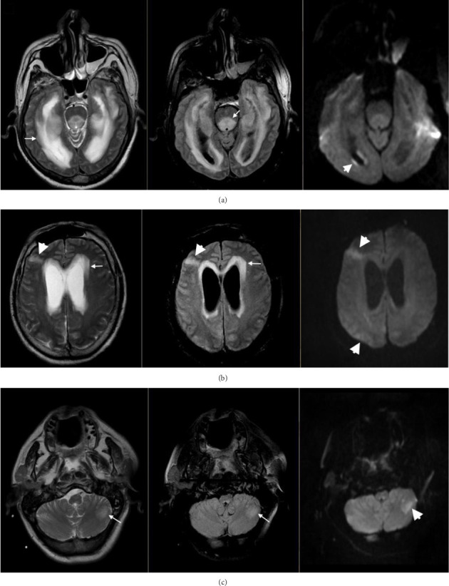 Clinical Presentations and Nosocomial Infections of Neurolisteriosis.