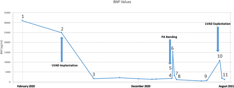 Successful Weaning off LVAD Support in an Infant by Pulmonary Artery Banding.