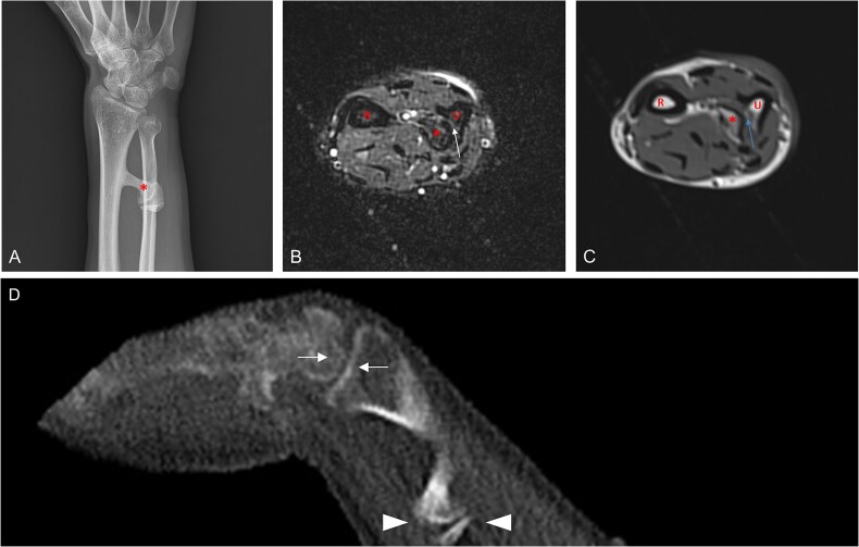 Ectopic pseudojoints in fibrodysplasia ossificans progressiva.