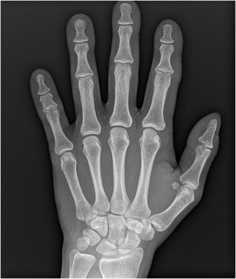 Management of failed carpal tunnel decompression.