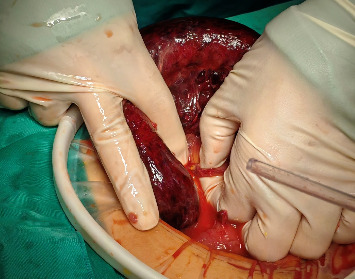 A Case of Strangulated Intestinal Obstruction Caused by Acquired Ileal Diverticulum.