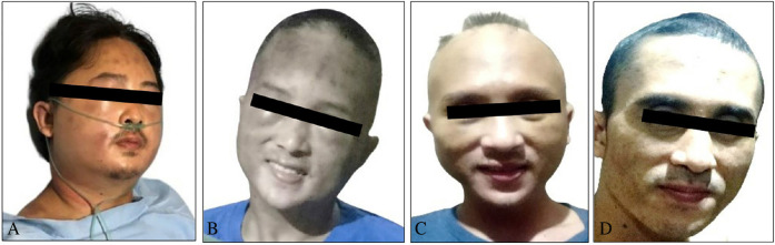 Rare head and neck myositis with reversible myelodysplastic syndrome: The first reported lupus manifestation as an initial symptom.