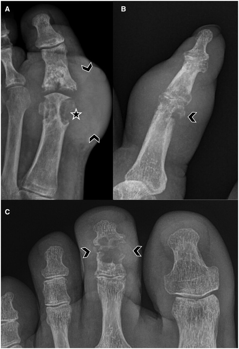 Imaging of gout: an atlas.