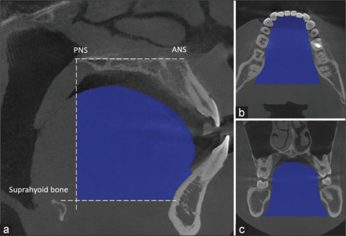 Which skeletal pattern should consider the correlation between the tongue volume versus the upper airway and craniofacial structure? A cross-sectional descriptive study in Vietnamese.