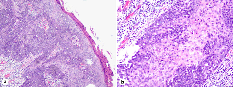Malignant Hidroacanthoma Simplex: A Case Report.