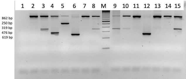Impact of Xmn1 polymorphism on hydroxyurea therapy in children with HbE-β non-transfusion dependent thalassemia: a cohort study.