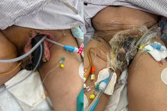 The role of double-lumen irrigation-suction tube in the treatment of disseminated Fournier's gangrene: a single-center retrospective cohort study.
