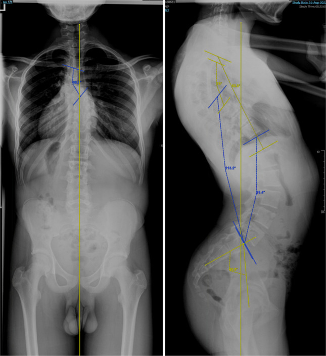 Surgical Sagittal Correction of Symptomatic Sweeping Thoracolumbar Lordosis in an Adolescent With Congenital Kyphoscoliosis.