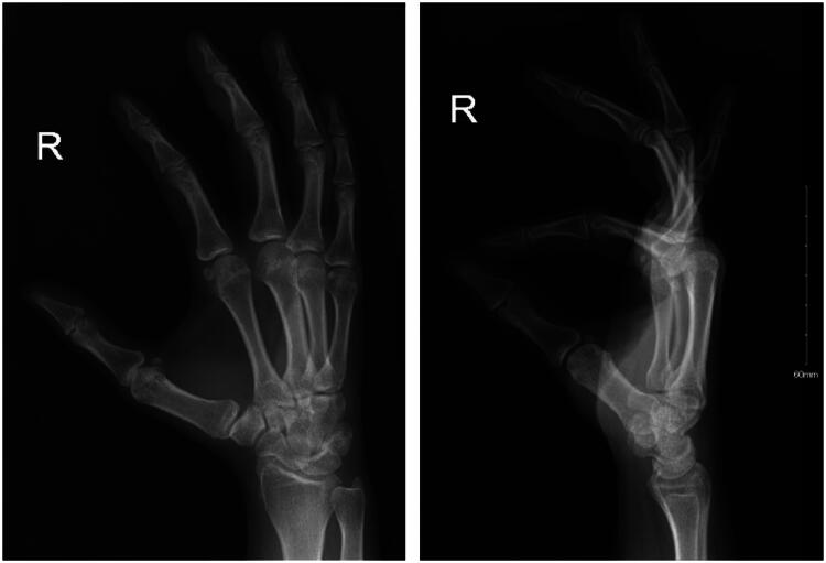Intravascular papillary endothelial hyperplasia (Masson's tumor) of the finger: a case report and review of the literature.