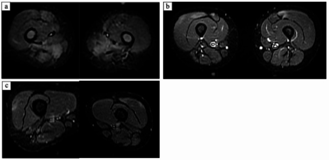 Pediatric immune-mediated necrotizing myopathy with anti-SRP antibodies targeting 19, 68, and 72 kda subunits.