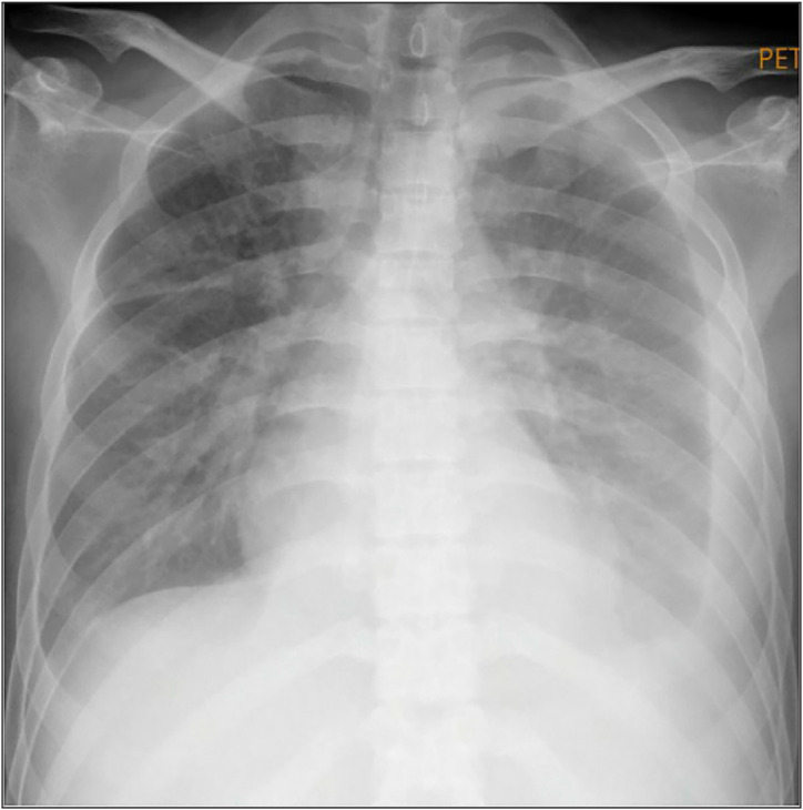 Rare head and neck myositis with reversible myelodysplastic syndrome: The first reported lupus manifestation as an initial symptom.