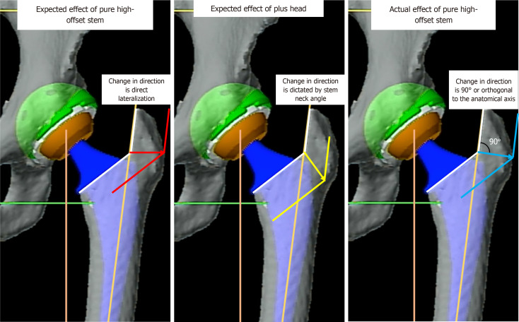 Pure high-offset stems can cause an unexpected increase in femoral length in robotic-assisted primary total hip arthroplasty.