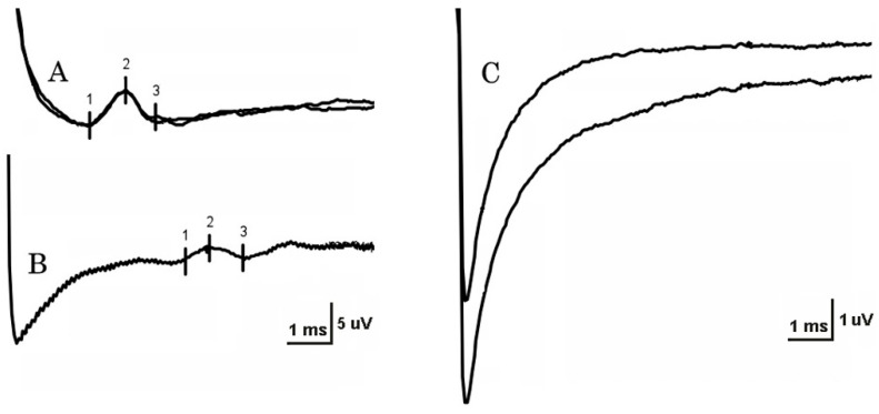 Electrodiagnostic Evaluation of Meralgia Paresthetica.