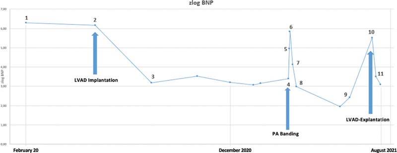 Successful Weaning off LVAD Support in an Infant by Pulmonary Artery Banding.