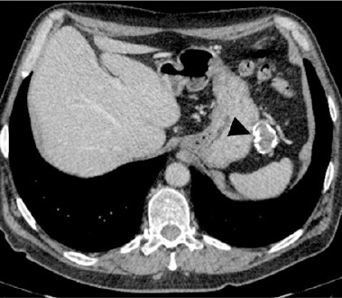 Anti-LGI1-antibody autoimmune encephalitis as a neurological paraneoplastic syndrome associated with gastrointestinal stromal tumour: a case report.