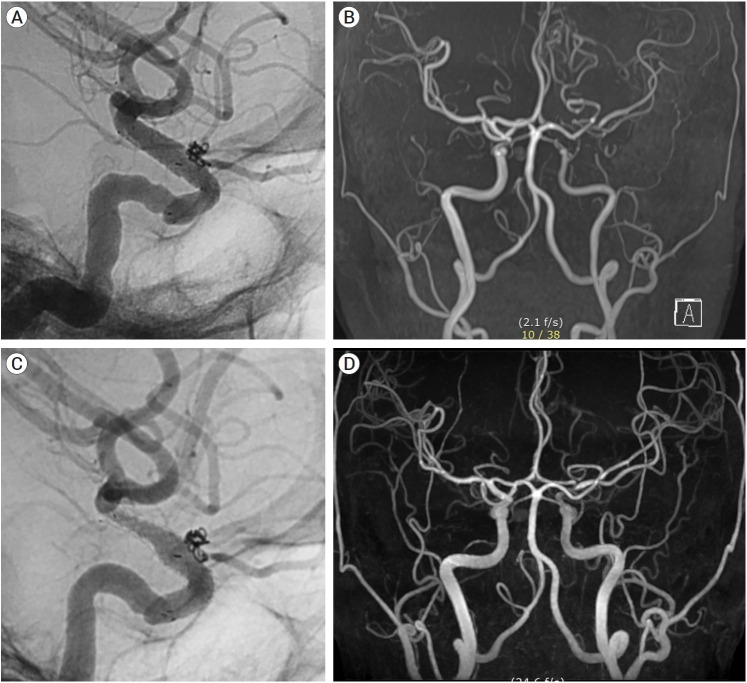 Clinical safety and efficacy of stent-assisted coil embolization with ACCERO stent in cerebral aneurysm: Short-term follow-up and precaution for use.