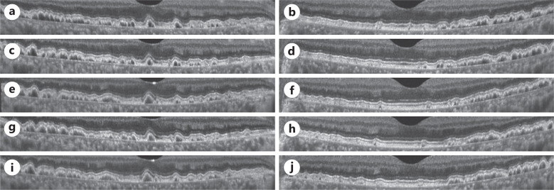 Morphological Changes in the Saw-Tooth Pattern of Cuticular Drusen Associated with Immune Complex-Mediated Membranous Proliferative Glomerulonephritis Type III: A Case Report.