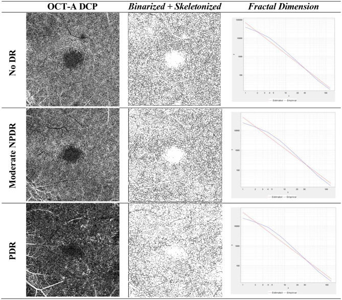 Retinal vessel tortuosity and fractal dimension in diabetic retinopathy.