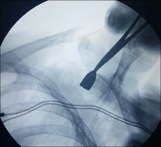 Firearm injuries in pediatric surgery: Pediatric trauma center experiences.