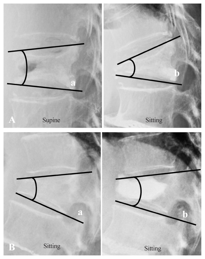 Evaluating the effect of early balloon kyphoplasty on adjacent vertebral fracture risk in osteoporotic vertebral fracture management: a retrospective study.