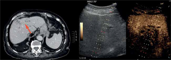 Application of contrast-enhanced ultrasound in liver biopsy.