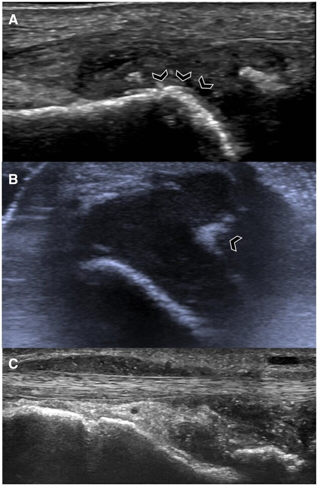 Imaging of gout: an atlas.