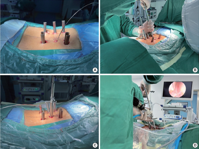 Endoscopic Decompression Combined With Percutaneous Pedicle Screw Fixation for AOSpine A3 or A4 Thoracolumbar Fractures With Neurological Deficits: A Retrospective Cohort Study.