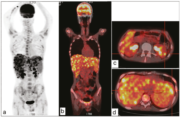 Disseminated candidiasis on FDG-PET/CT.