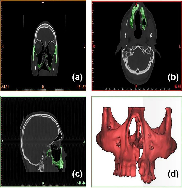 Evaluation of Stress in the Maxillary Complex of a Unilateral Cleft Lip and Palate on Simulated Occlusal Loading Using Finite Element Analysis.