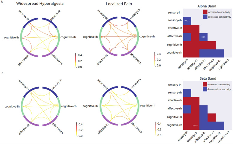 Disruptions in cortical circuit connectivity distinguish widespread hyperalgesia from localized pain.