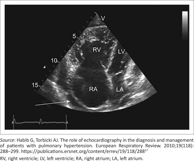 An approach to heart failure for the public-sector primary care clinician.