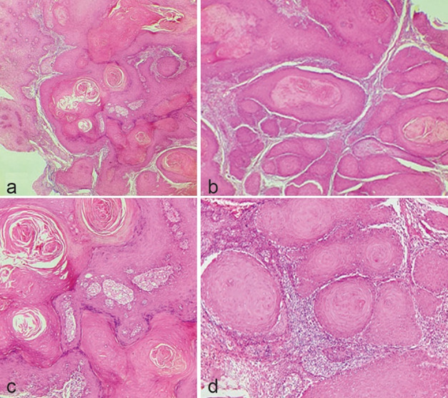 Infrequent Histopathologic Subtypes of Oral Squamous Cell Carcinoma: A Case Series with Emphasis on Histopathologic Characteristics.