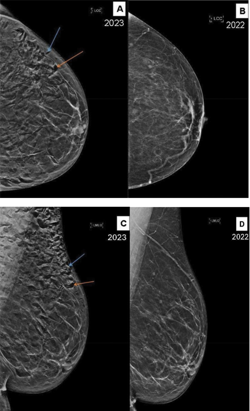 Pneumomastia: A Rare but Benign Mammographic Finding.
