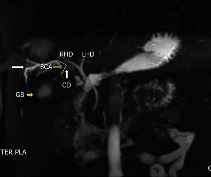 Calculus Cholecystitis Complicated with Variations of Extrahepatic Bile Duct: Clinical Experience and Aeromedical Analysis of 3 Cases in Aviation Pilots.