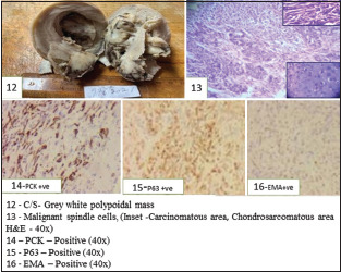Carcinosarcoma of Uterus and Ovary-Clinical, Morphological, and Immunohistochemical Study of Case Series.