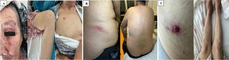 Rickettsiosis cases presenting with rash: a case series from an endemic region in Turkey.