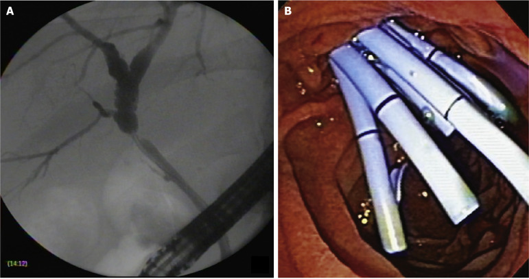 Long-term outcomes of post-transplant biliary anastomotic strictures: Endoscopic therapy with plastic and metal stents.