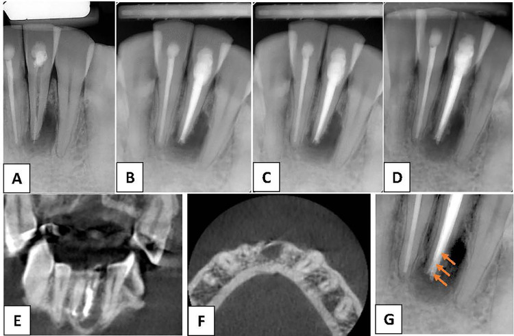 Case Report: Apical periodontitis due to calculus-like deposit on the external surface of the root apex.